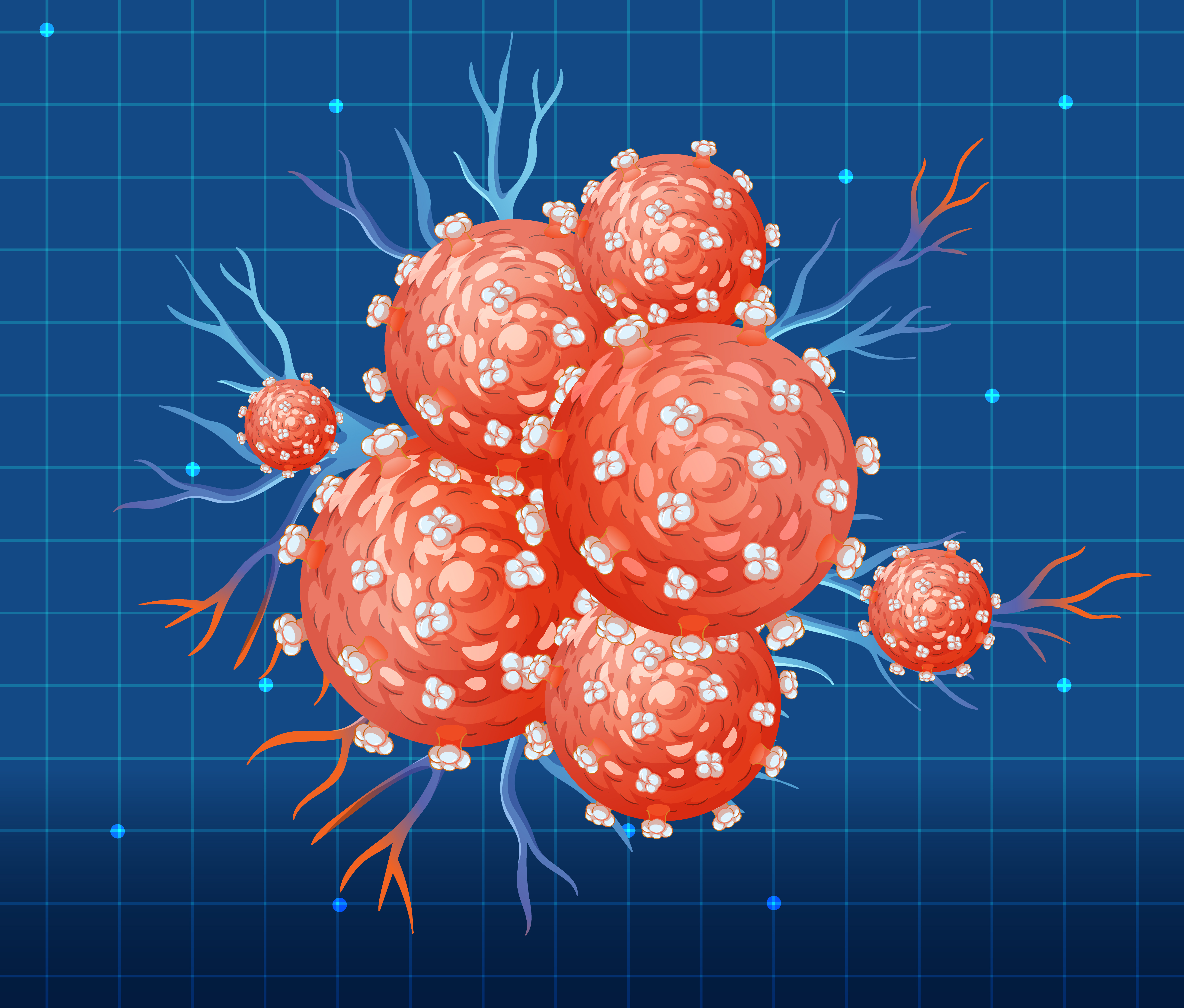 Stadiile cancerului rectal